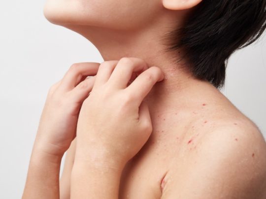 首周りにできる湿疹の症状と主な原因！痒みの対策や皮膚科受診も！